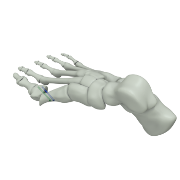 Hallux Valgus
