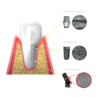 Dental Implant 1